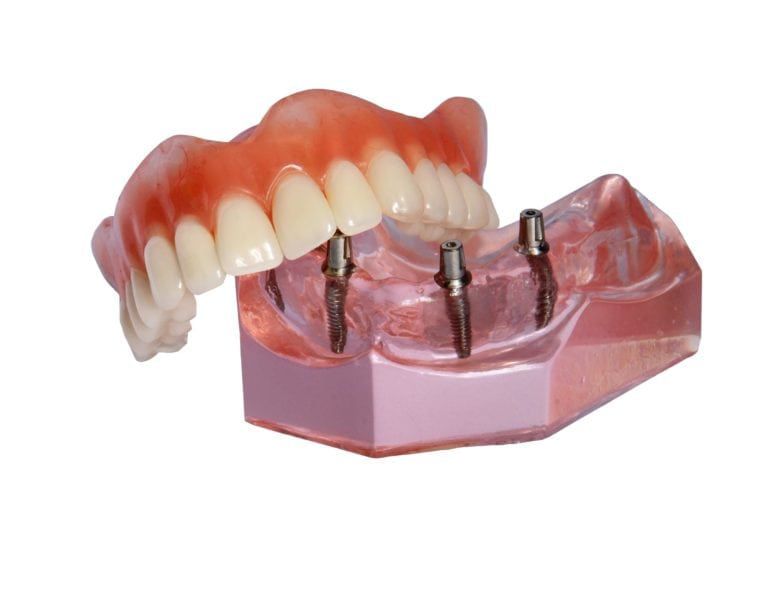 dental implants