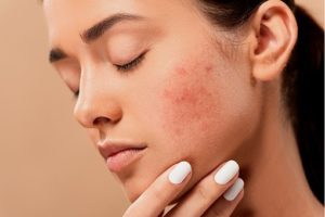 pimples-acne